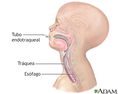 Intubación endotraqueal