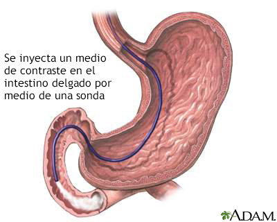 Inyección de contraste en el intestino delgado - Miniatura de ilustración
              