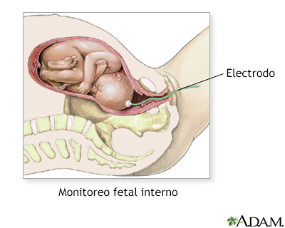 Monitorización fetal interna