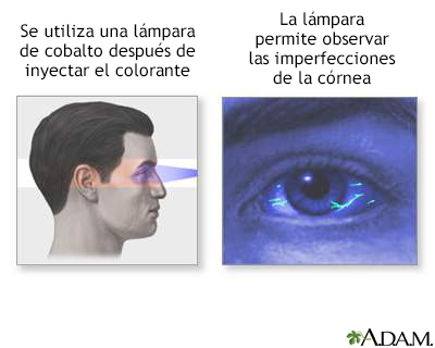 Examen de fluoresceína en el ojo - Miniatura de ilustración
              