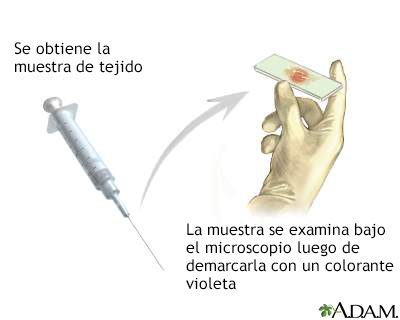 Tinción de gram de biopsia tisular - Miniatura de ilustración
              