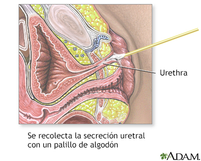 Tinción de Gram de la secreción uretral - Miniatura de ilustración
              
