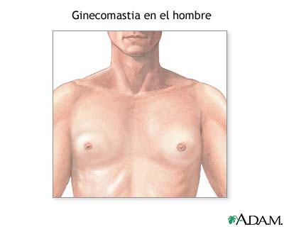 Ginecomastia - Miniatura de ilustración
              
