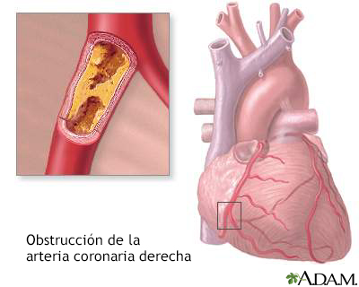 Obstrucción de las arterias coronarias
