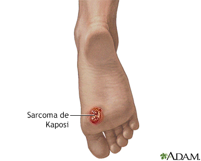 El sarcoma de Kaposi en el pie - Miniatura de ilustración
              