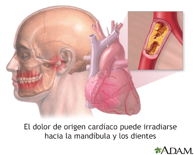 Dolor de mandíbula y ataques cardíacos - Miniatura de ilustración
              