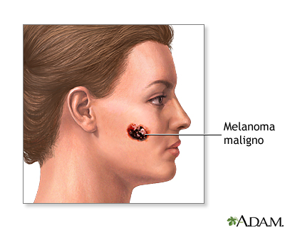 Melanoma maligno - Miniatura de ilustración
              