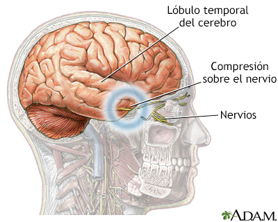 Hernia cerebral - Miniatura de ilustración
              