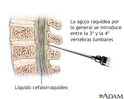 Punción lumbar