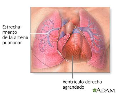 Hipertensión pulmonar primaria - Miniatura de ilustración
              