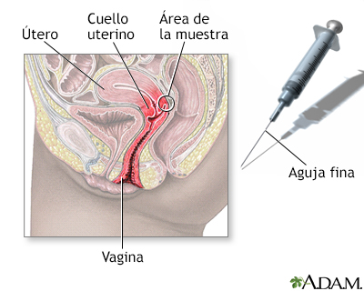 Toma de muestra con aguja del cuello uterino - Miniatura de ilustración
              