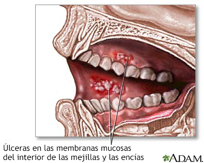 Úlceras de la boca - Miniatura de ilustración
              