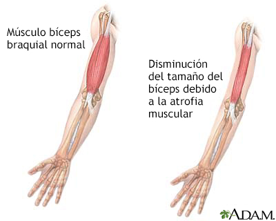 Atrofia muscular - Miniatura de ilustración
              