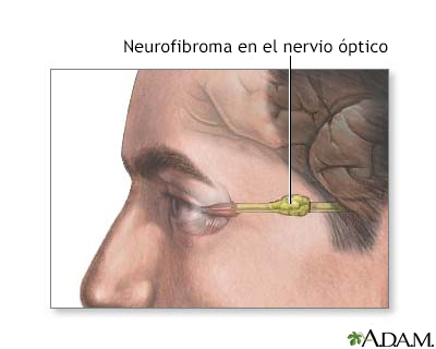 Neurofibroma