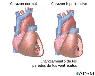 Hipertensión - Miniatura de ilustración
              