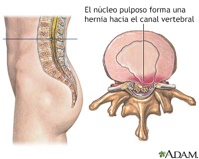 Núcleo pulposo herniado - Miniatura de ilustración
              