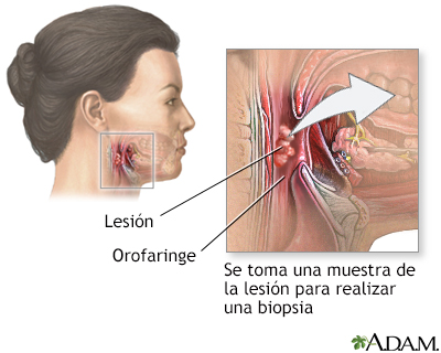 Biopsia orofaríngea