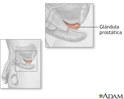 Glándula prostática - Miniatura de ilustración
              