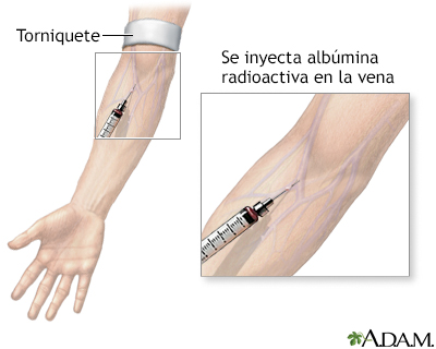 Inyección de albúmina