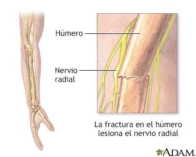 Disfunción del nervio radial - Miniatura de ilustración
              