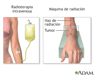 Terapia de radiación - Miniatura de ilustración
              
