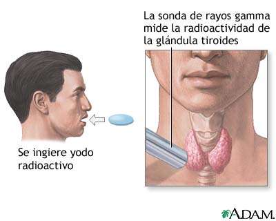 Prueba de captación de tiroides - Miniatura de ilustración
              