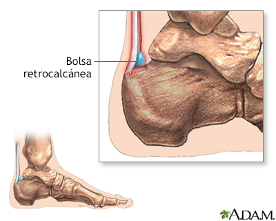 Bursitis retrocalcánea