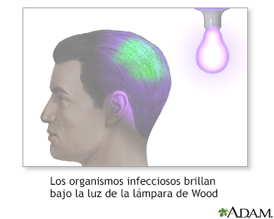 Image: Vitiligo resaltado bajo una lámpara de Wood - Manual Merck versión  para profesionales