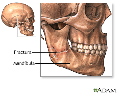 Fractura mandibular - Miniatura de ilustración
              