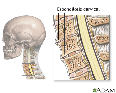 Espondilosis cervical - Miniatura de ilustración
              