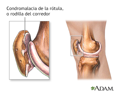 Cinta Rotuliana Para Dolor de Rodilla y Tendinitis Rotuliana 