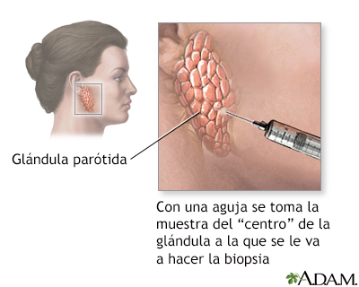 Biopsia de glándula salival - Miniatura de ilustración
              