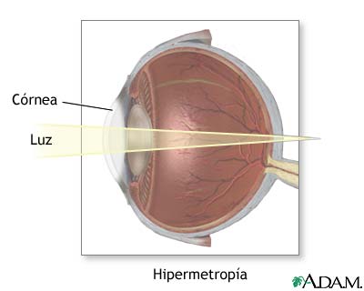 Hipermétrope