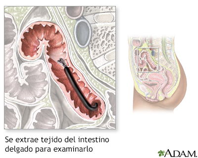 Muestra de tejido del intestino delgado - Miniatura de ilustración
              