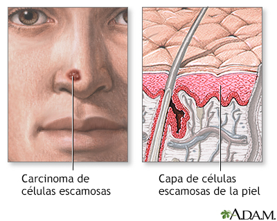 Cáncer de células escamosas