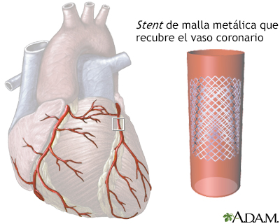 Stent de arteria coronaria