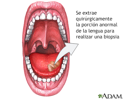 Biopsia lingual - Miniatura de ilustración
              