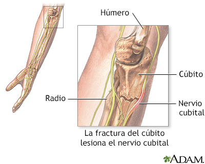 Daño del nervio cubital - Miniatura de ilustración
              