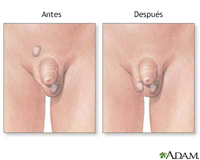 Antes y después de la reparación testicular
