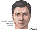Vitiligo