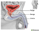 Prostatectomia - série
