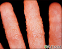 Dermatite, reação à tinea
