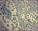 Abscesso cerebral amébico