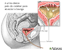 Cateterização da bexiga, mulheres