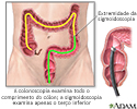 Colonoscopia