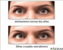Estrabismo
