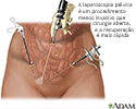 Laparoscopia pélvica