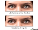 Estrabismo divergente