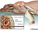 Aspiração de medula óssea