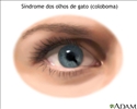 Síndrome dos olhos de gato